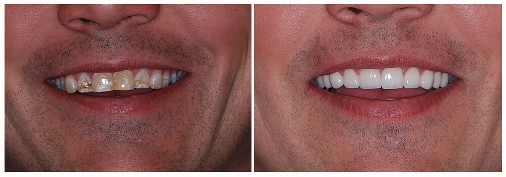 The before and after a man's smile